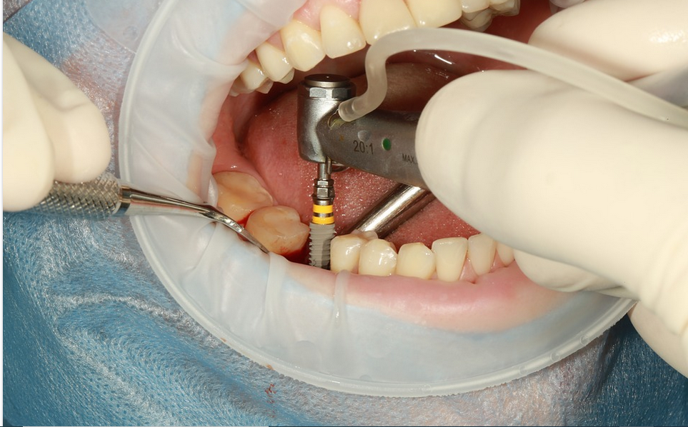 dental implant procedure